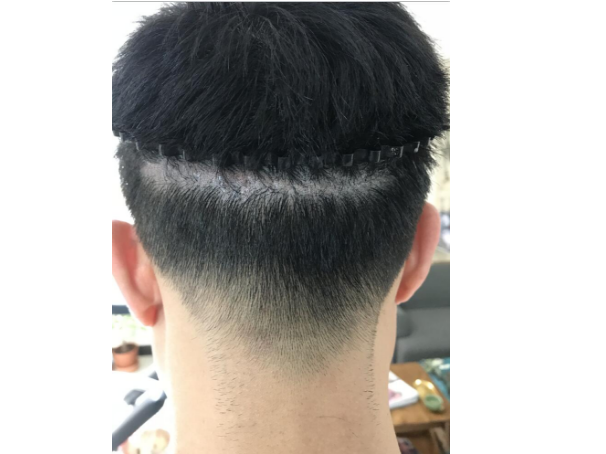 上海正规疤痕植发医院有哪些