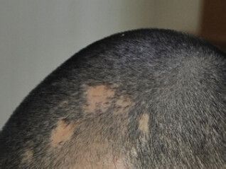 疤痕五个月能植发吗