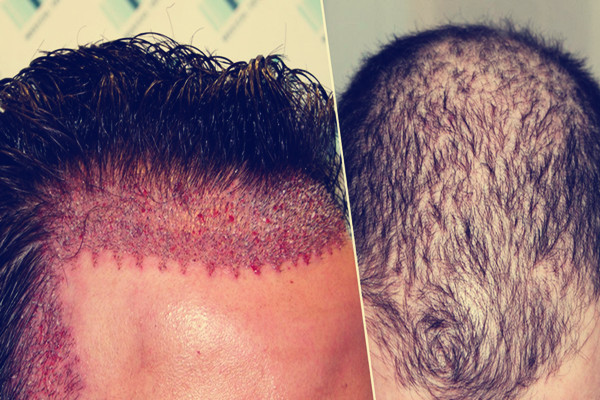 毛发移植后伤口疼是怎么回事
