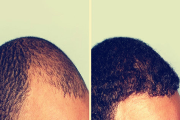 毛发移植的对脑有危害吗？