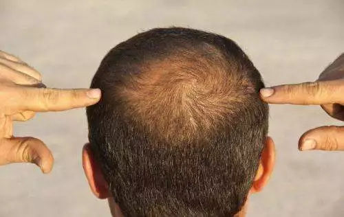 遗传的脂溢性脱发是否可以通过植发手术来完全治愈？