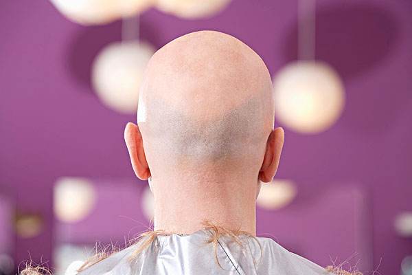溢脂性脱发原因及治疗