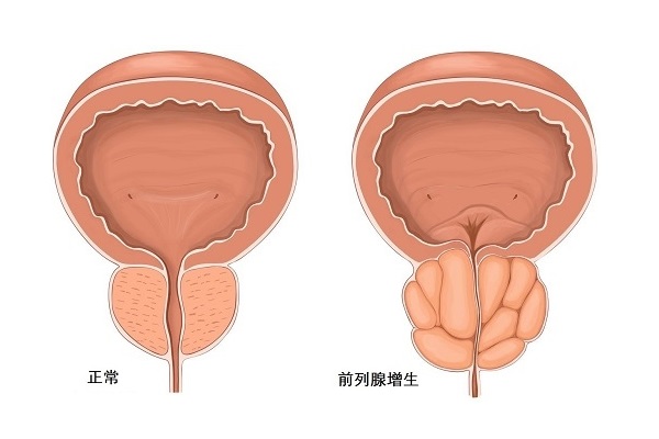 非那雄胺片是前列腺的吗