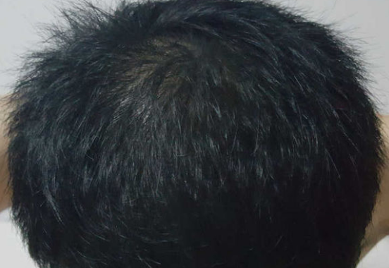 雄性脱发和脂溢性脱发是一回事吗？