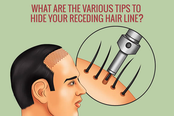 毛发移植区取发区怎么护理