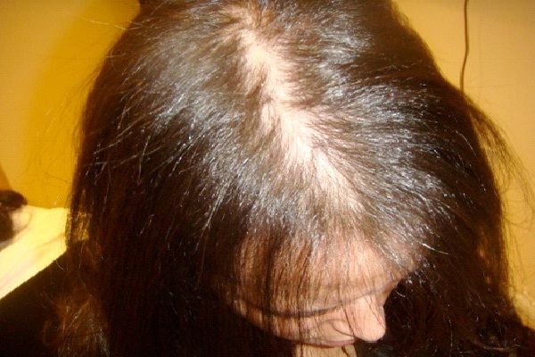 产后掉头发能预防吗