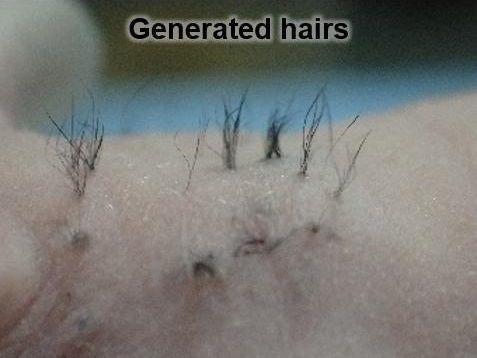脱发患者的福音：科学家成功用干细胞培养出大量毛囊胚