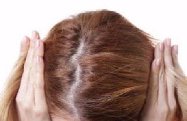油脂性脱发是什么病