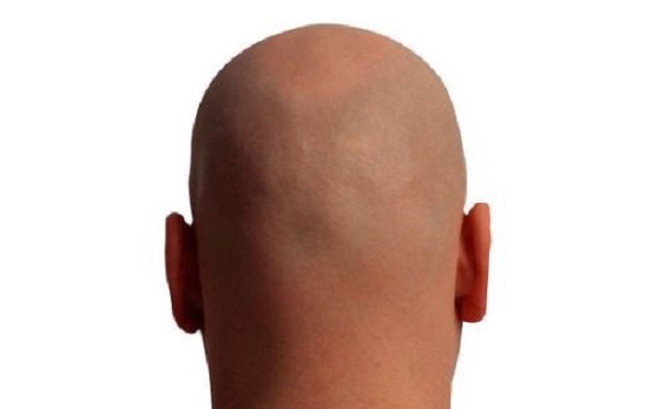 秃头是基因的问题吗