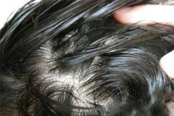 溢脂性脱发有什么症状