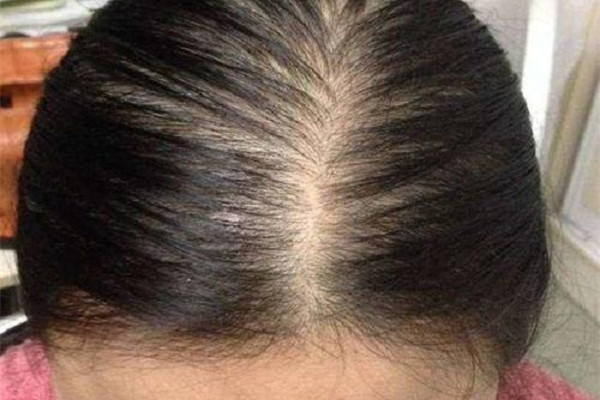 头发扎太紧是导致发际线后移的原因吗?