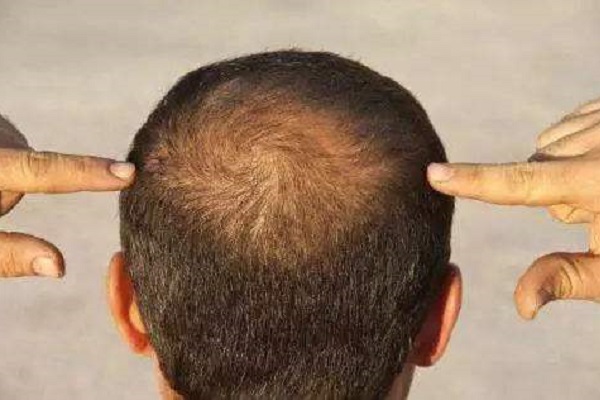 男性补充雌激素可以治疗脱发吗?