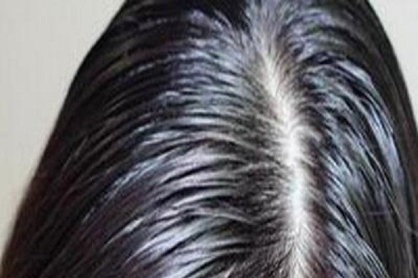 补充钙质能防止头发脱发吗
