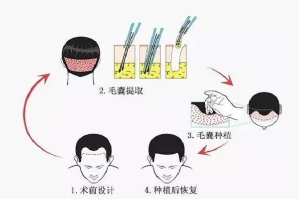 种头发手术过程