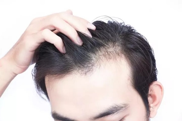 种头发对油脂性脱发有效果吗