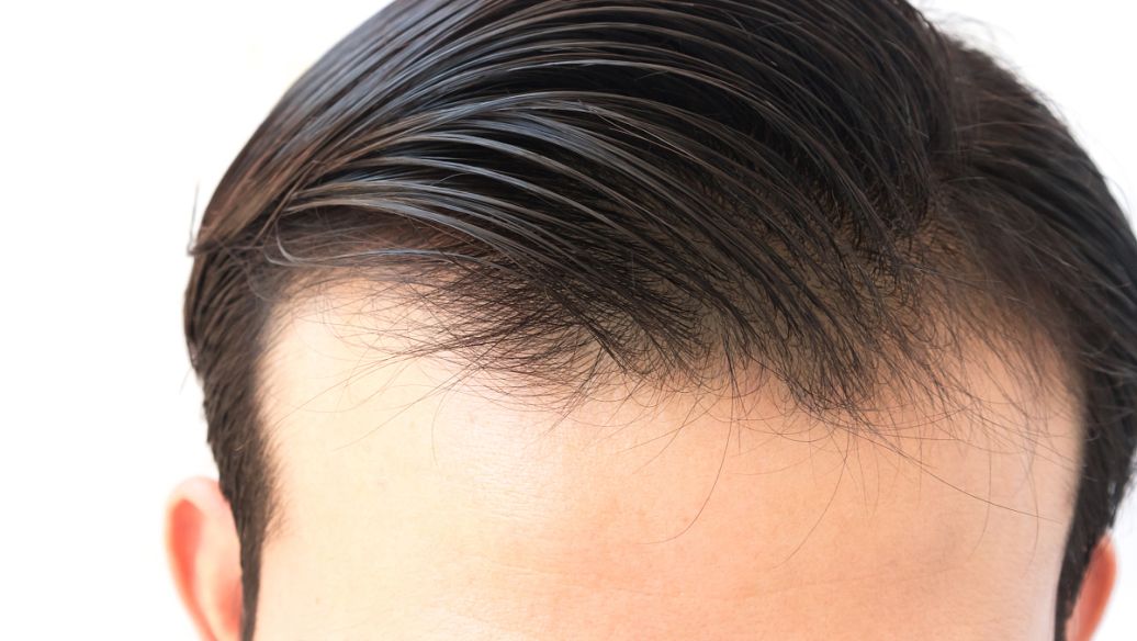 发际线植发有副作用吗?