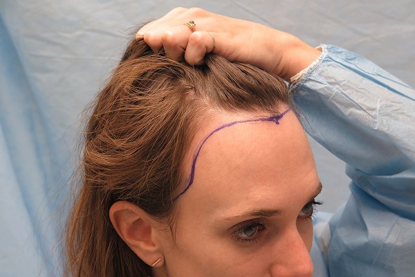 植发重塑发际线可行吗？