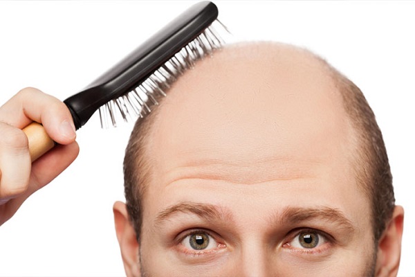 为什么有的人头顶发量少却不适合植发?