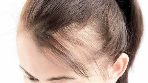 女性头顶稀疏可以做植发吗?