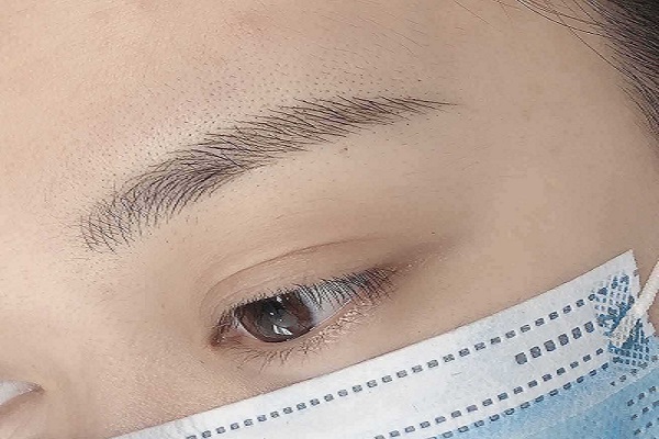 眉毛种植手术真的有效吗
