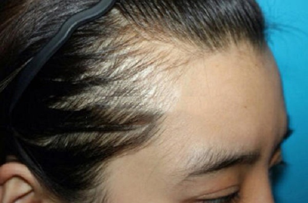女性做植发手术加密头顶头发的过程是怎样的?