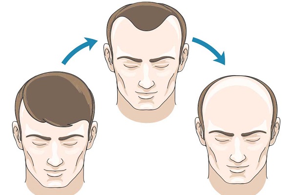 脱发是怎么一步步发展成秃顶的