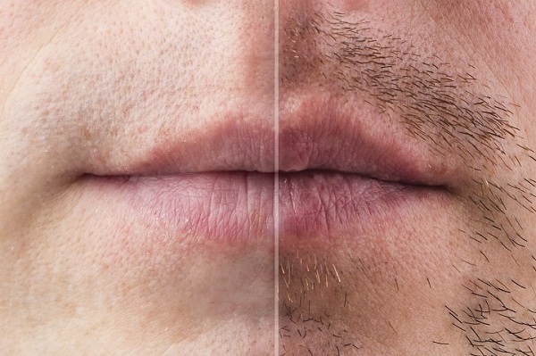 胡须移植有后遗症吗?