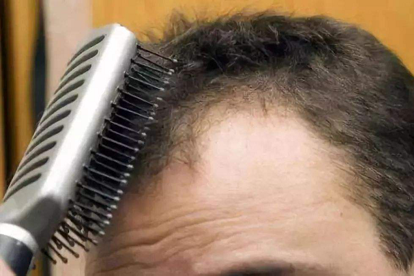 先天性脱发是哪些原因引起的