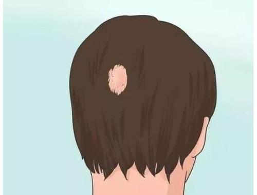 FUT植发可以消除疤痕吗?