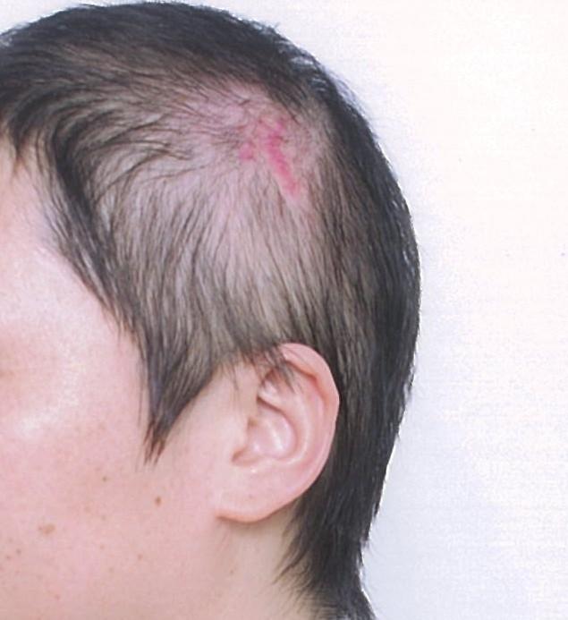 疤痕性脱发植发后要多久才能长好?
