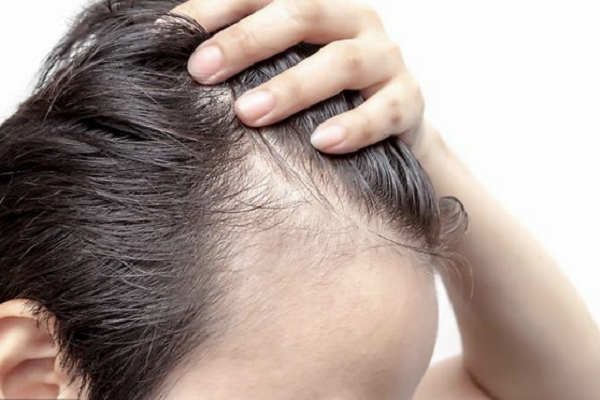 可以长期服用养血生发胶囊预防脱发吗