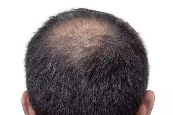 先天性脱发是绝症吗
