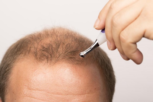 脱发秃顶初期有什么预兆吗