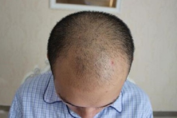 治疗男性脂溢性脱发的偏方有哪些