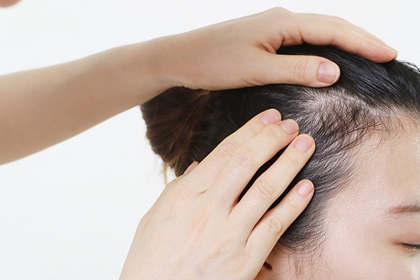 脂溢性脱发有哪些常见症状