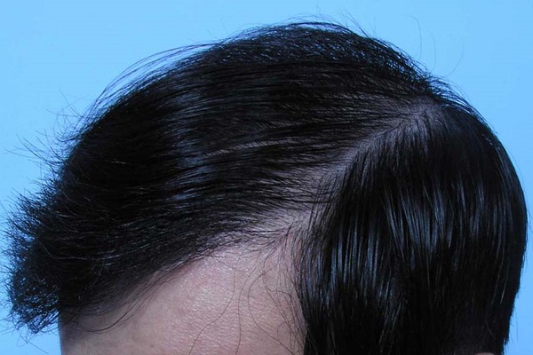脂溢性脱发有哪些常见特征