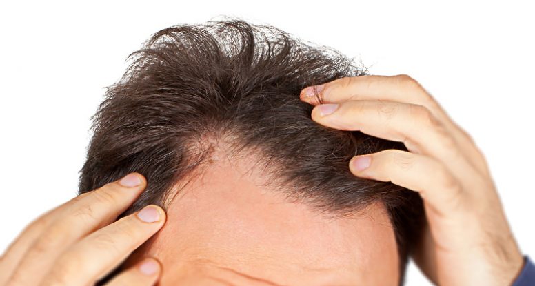 男性额头两侧脱发发际线后移应该吃什么药缓解