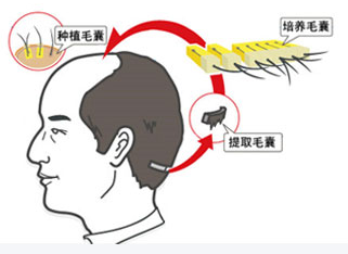 植发总的费用多少钱