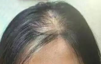 女性头顶稀可以植发吗