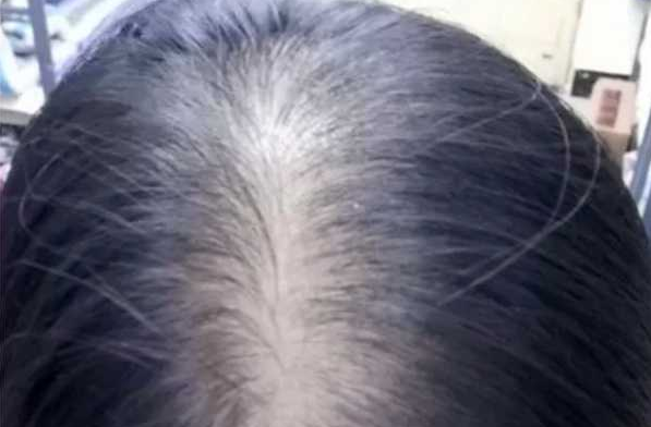 女性做头发加密用什么植发技术比较好