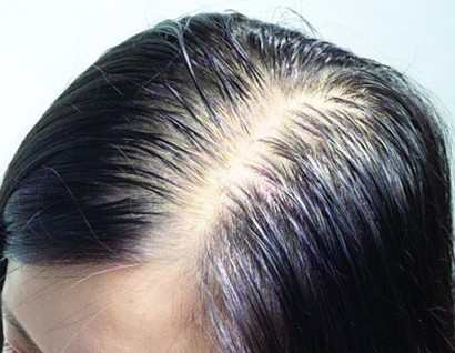 米诺地尔对脂溢性脱发有效吗