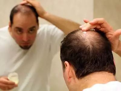 脂溢性脱发的原因是什么