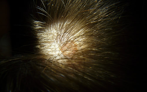 脂溢性脱发根本原因是什么