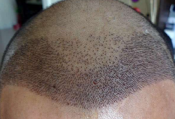 植发手术，治疗脱发的终极方案