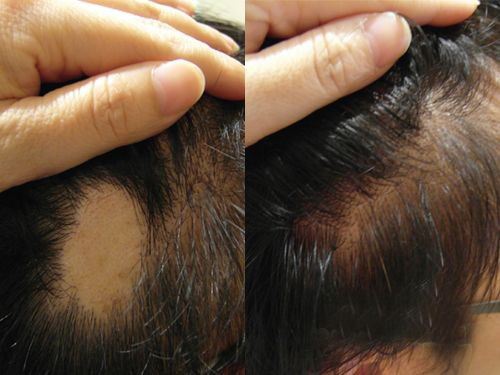 治疗斑秃，脂溢性脱发，神经性脱发的外搽剂