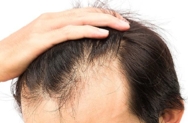 脂溢性脱发有可能完全治愈吗?