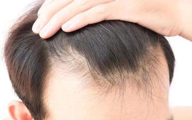 肾虚会导致脱发吗，如果会，会怎么脱?