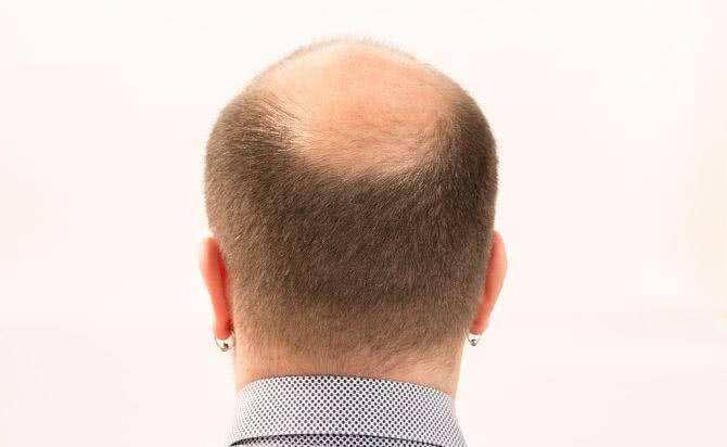 年轻秃顶的原因是什么？