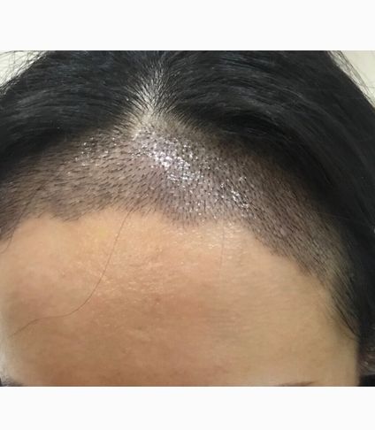 脂溢性脱发如何生发？