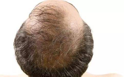 如何治疗脱发?了解秃顶的原因!
